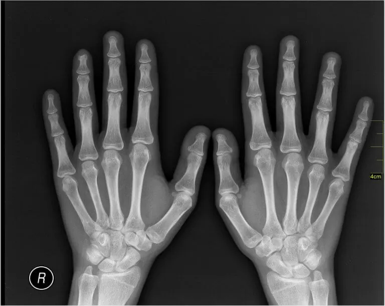 Medical X-Ray imaging of hands